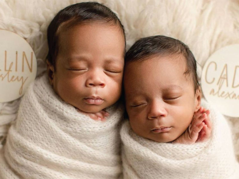 TTTS Foundation helps Twins to be born healthy