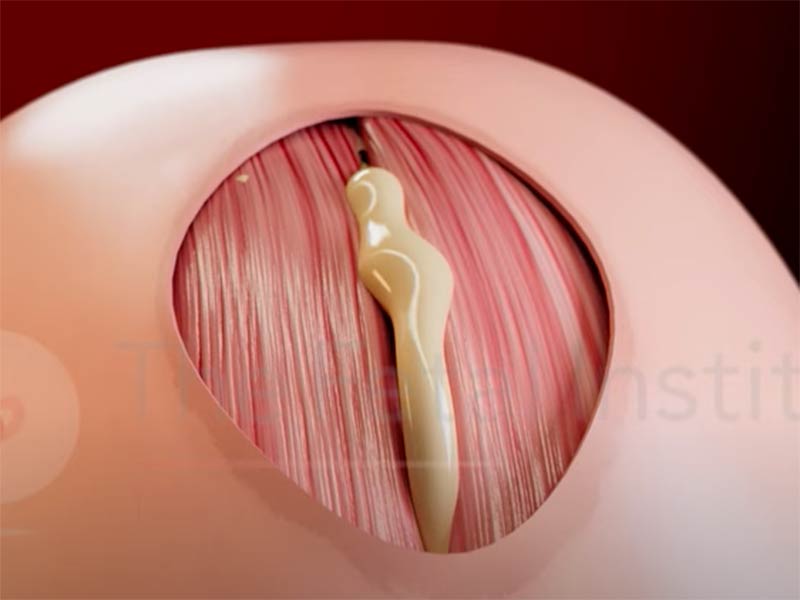 Percutaneous mini-laparotomy fetoscopic treatment of Open Spina Bifida